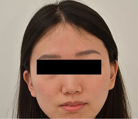 Hairline Lowering Before & After