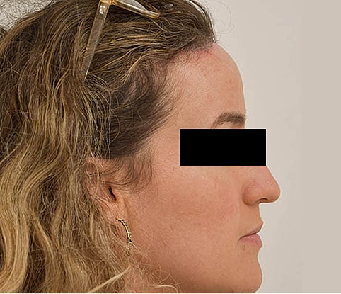 Hairline Lowering Before & After