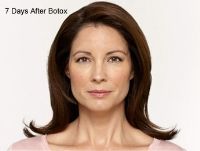 Dermal Fillers Before & After