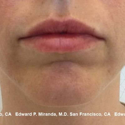 Dermal Fillers Before & After