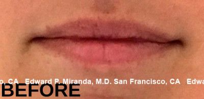 Dermal Fillers Before & After