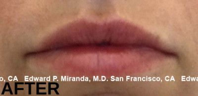 Dermal Fillers Before & After
