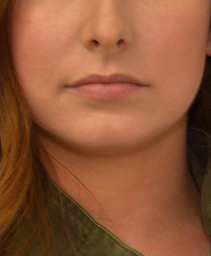 Dermal Fillers Before & After