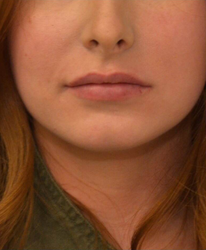 Dermal Fillers Before & After