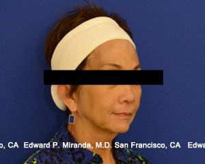 Dermal Fillers Before & After