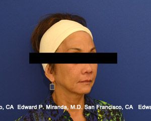 Dermal Fillers Before & After