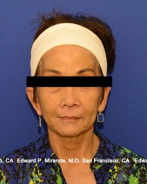 Dermal Fillers Before & After