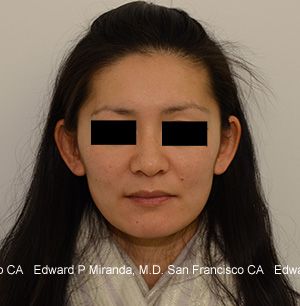 Dermal Fillers Before & After