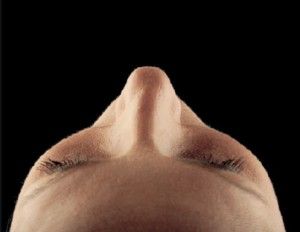 Dermal Fillers Before & After