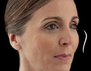 Dermal Fillers Before & After