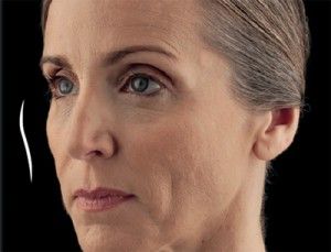 Dermal Fillers Before & After