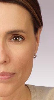 Dermal Fillers Before & After