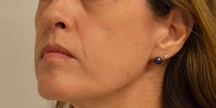 Dermal Fillers Before & After