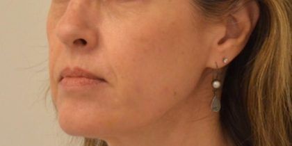 Dermal Fillers Before & After