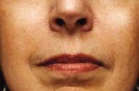 Dermal Fillers Before & After