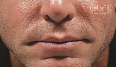 Dermal Fillers Before & After