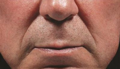 Dermal Fillers Before & After