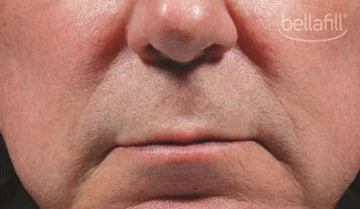 Dermal Fillers Before & After