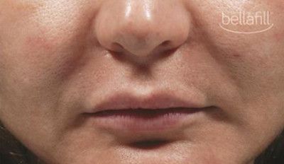 Dermal Fillers Before & After