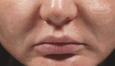 Dermal Fillers Before & After