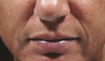 Dermal Fillers Before & After