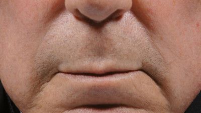 Dermal Fillers Before & After