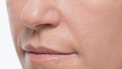 Dermal Fillers Before & After