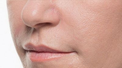 Dermal Fillers Before & After