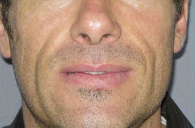 Dermal Fillers Before & After