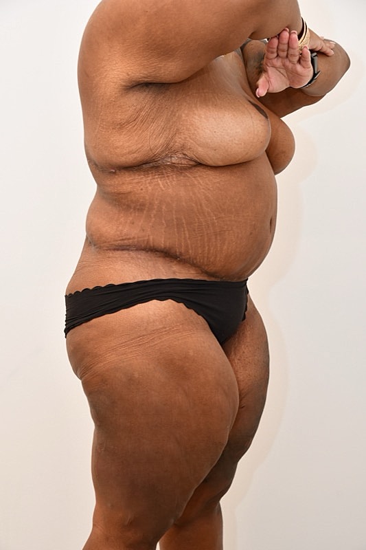 Body Lift Before & After
