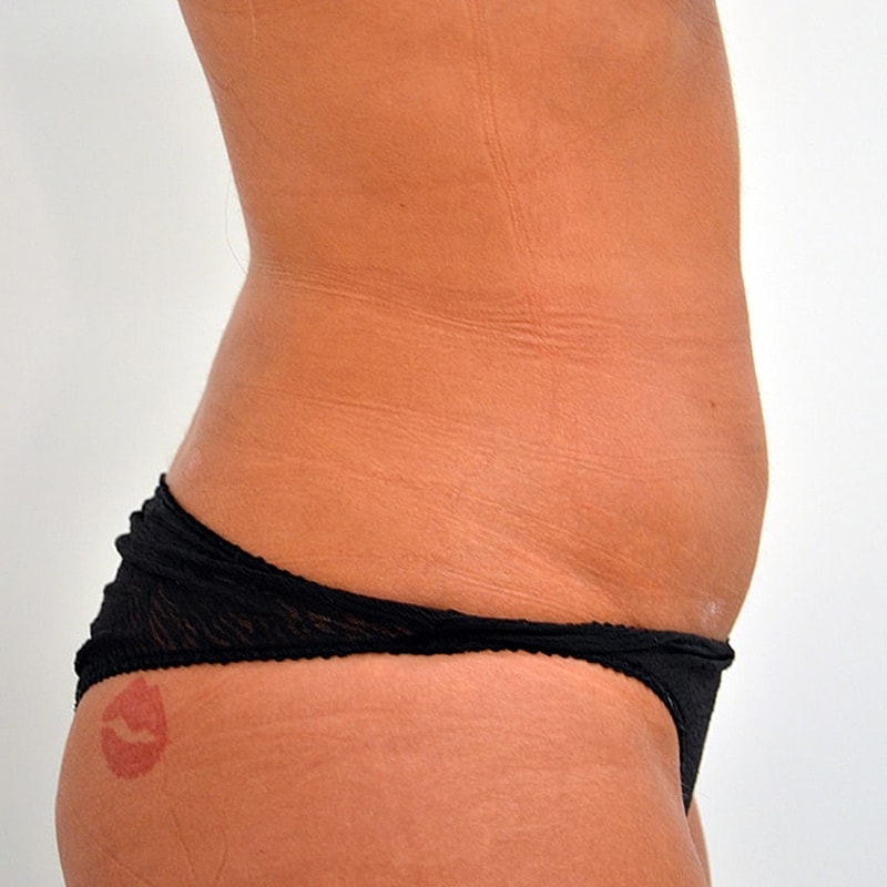 Liposuction Before & After