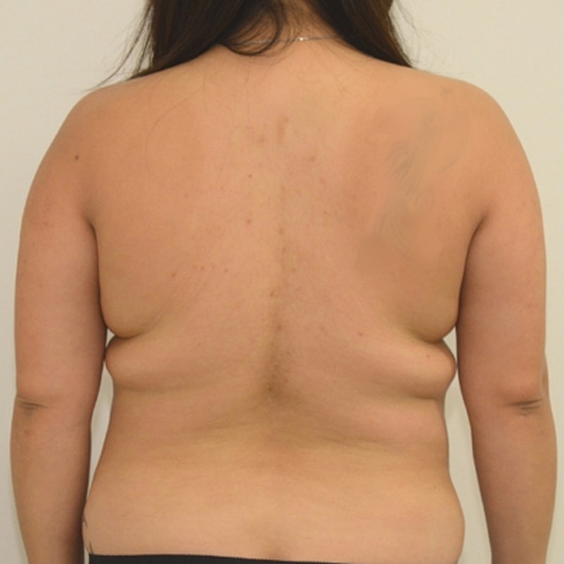 Liposuction Before & After