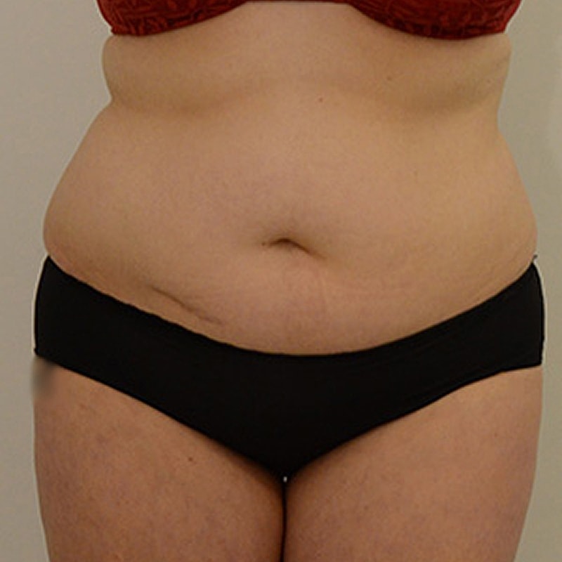 Liposuction Before & After 