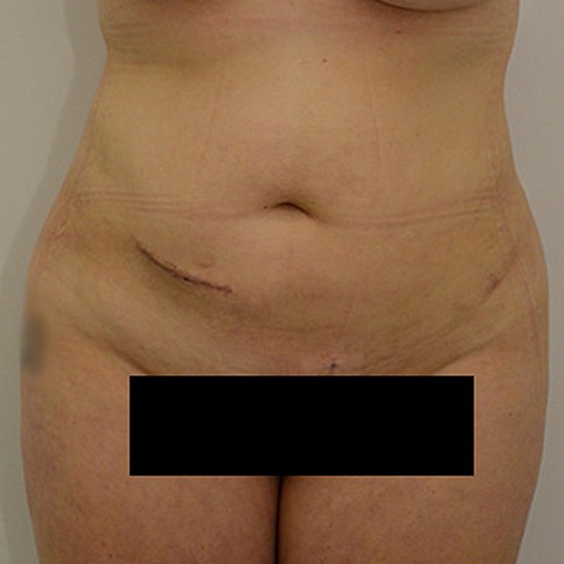 Liposuction Before & After