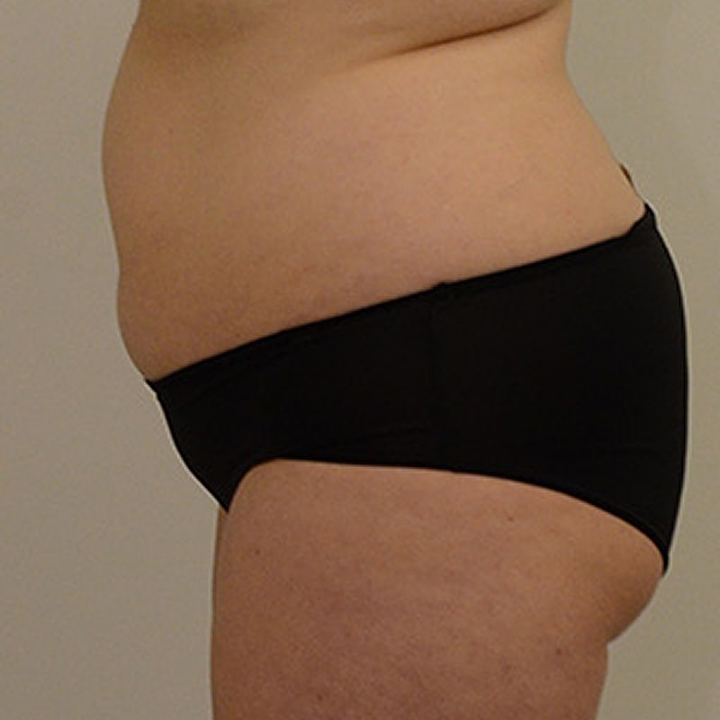 Liposuction Before & After