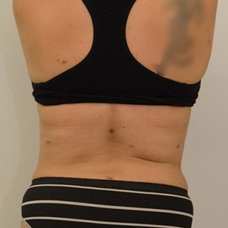 Liposuction Before & After