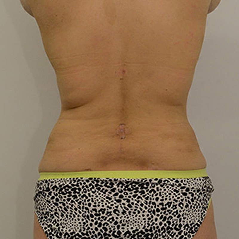 Liposuction Before & After