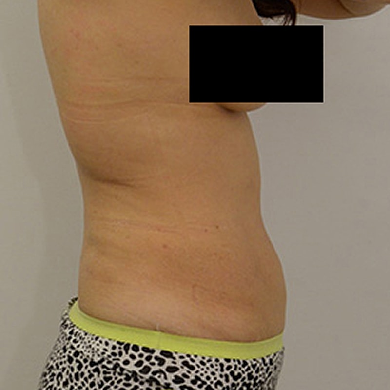Liposuction Before & After