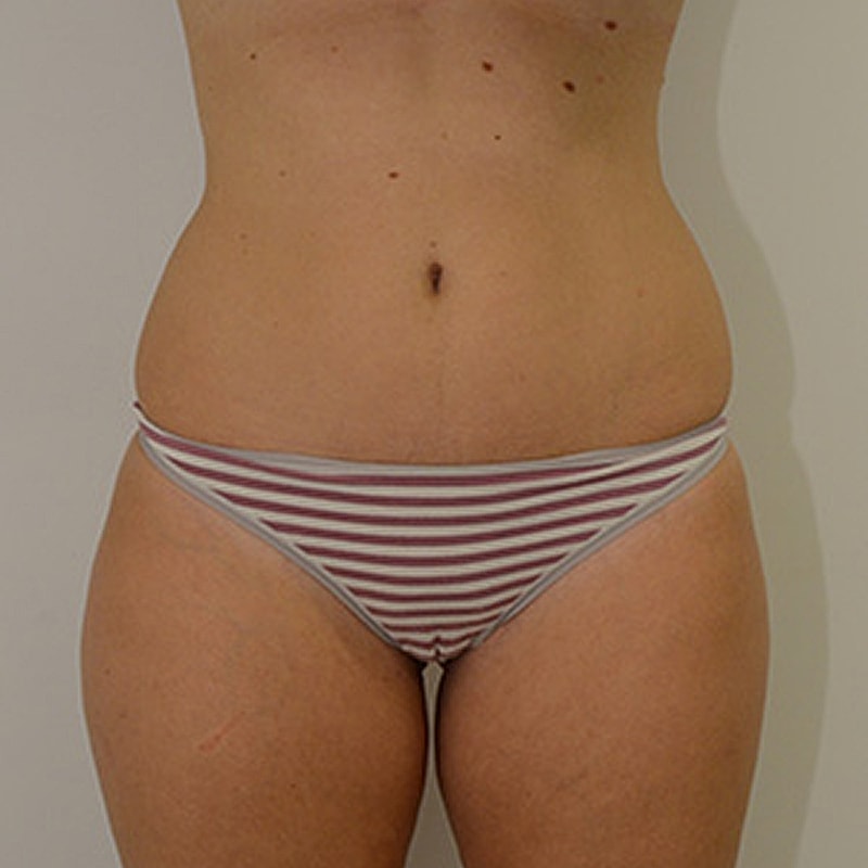Liposuction Before & After