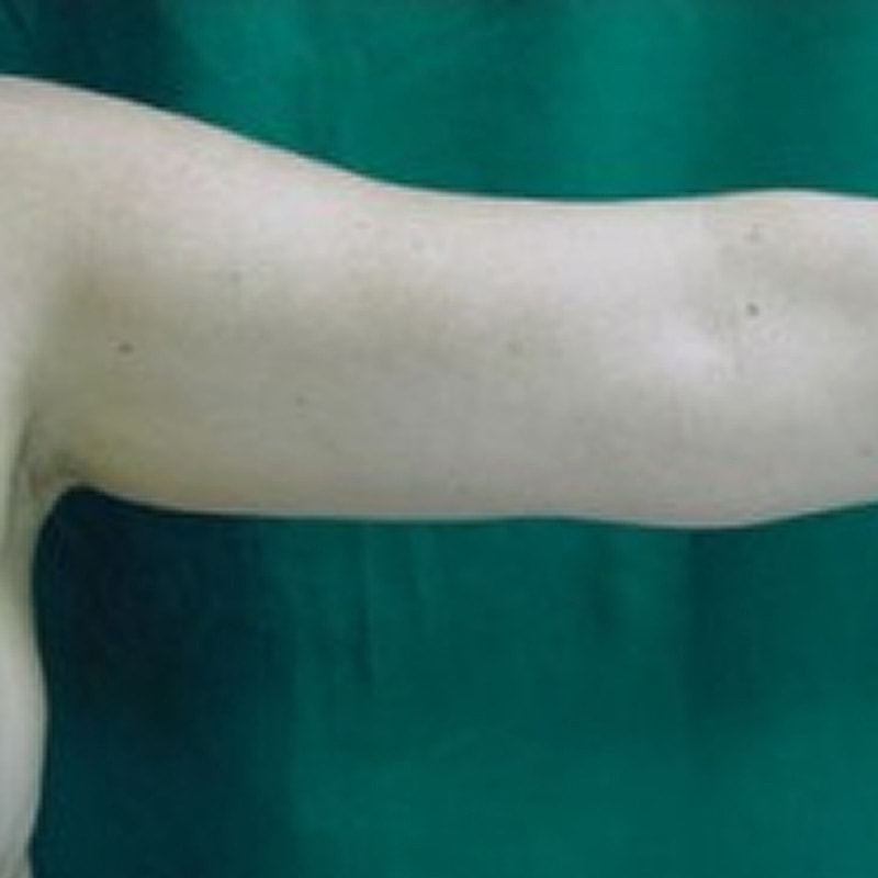 Liposuction Before & After