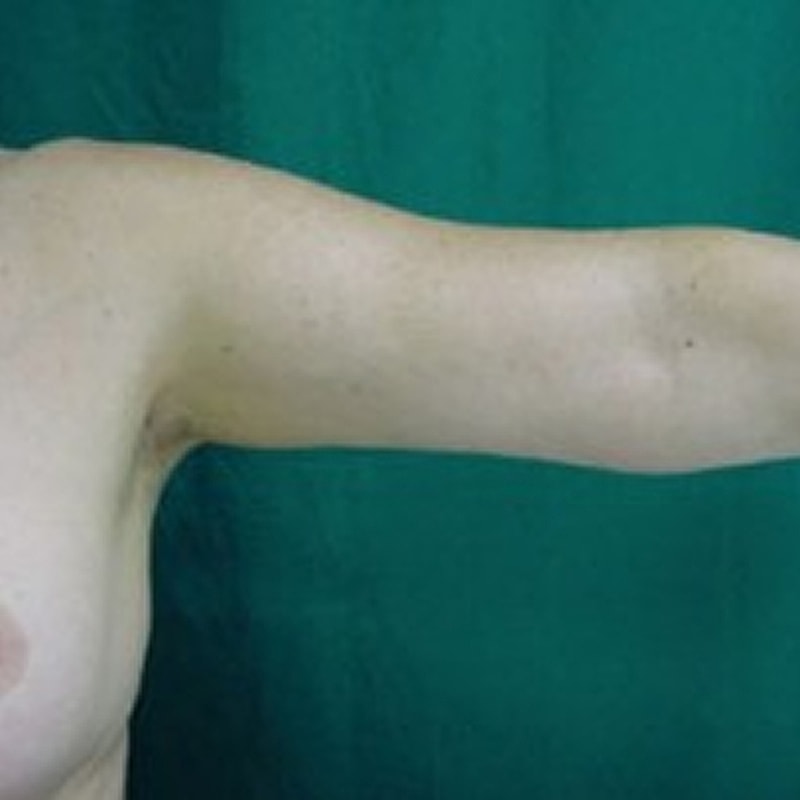 Liposuction Before & After