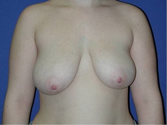 Breast Reduction Before & After