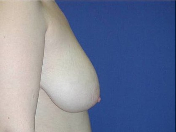 Breast Reduction Before & After
