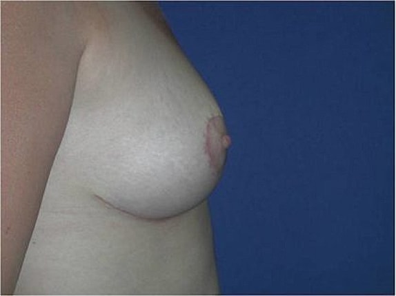 Breast Reduction Before & After
