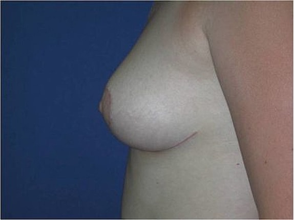 Breast Reduction Before & After