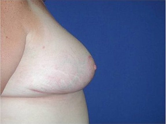 Breast Reduction Before & After