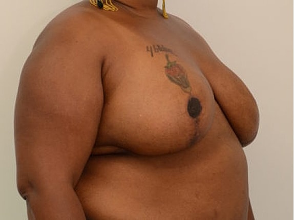 Breast Reduction Before & After