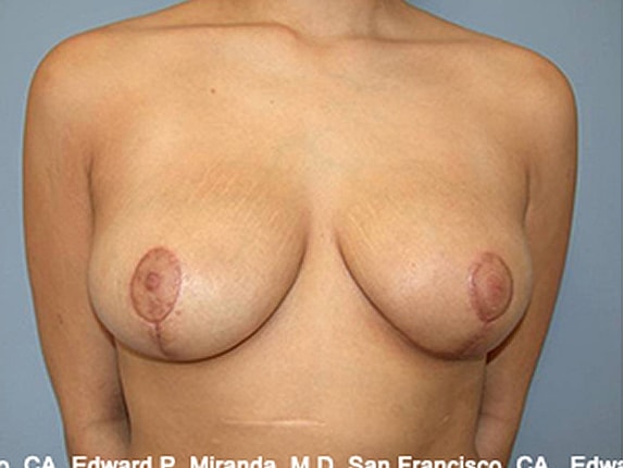 Breast Reduction Before & After