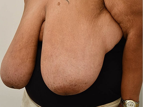 Breast Reduction Before & After
