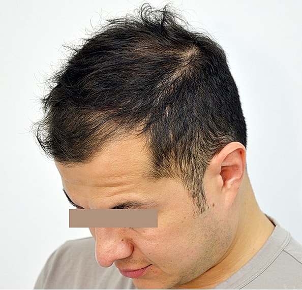 Hair Transplant Before & After